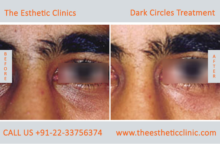 Under Eye Dark Circle Removal Laser Treatment before after photos in mumbai india (5)